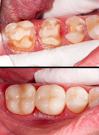 Synergy Dental Specialists | Oral Cancer Screening, Extractions and Sinus Lifts