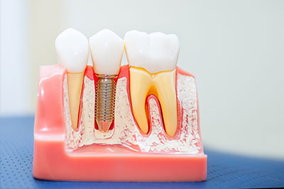 Synergy Dental Specialists | Oral Cancer Screening, Sedation Dentistry and Periodontic Plastic Surgery