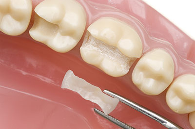 Synergy Dental Specialists | Wisdom Teeth Removal, Extractions and Laser Dentistry