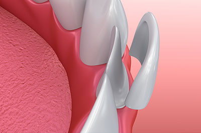 Synergy Dental Specialists | Preventative Program, Bone Grafts and Oral Cancer Screening